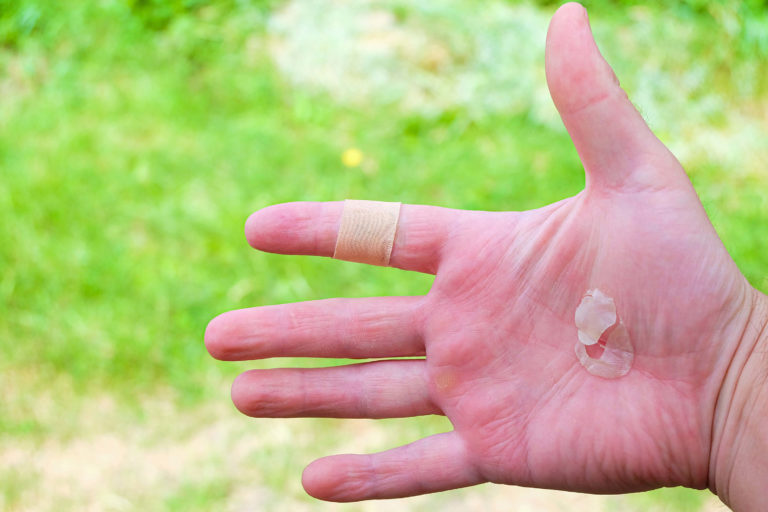 ゴルフのまめができる原因を左手と右手に分けて解説 最短での治し方は ゴルフのまめができる原因を左手と右手に分けて解説 最短での治し方は